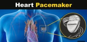 How much is a pacemaker